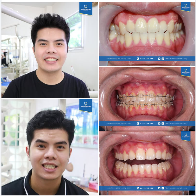 1 ca niềng răng xong đẹp trai ngời ngời