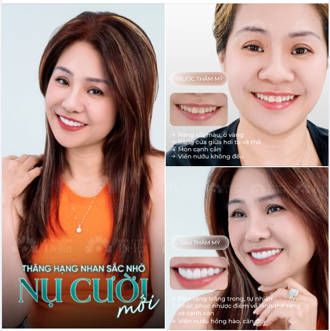 Thăng hạng nhan sắc nhờ nụ cười mới