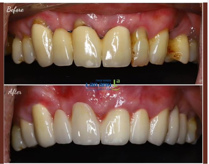 Răng sứ cũ làm ở nơi khác, bị hở và vênh, được làm lại tại nha khoa Lan Anh ạ