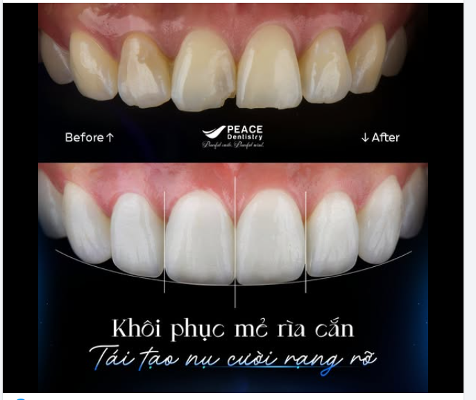 Có phải bạn cho rằng một vết mẻ nhỏ ở răng cửa là không đáng kể?