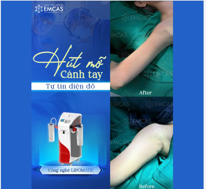 Thay đổi để đẹp hơn, tự tin chọn trang phục mà không lo khuyết điểm cánh tay to, thô, xồ xề mỡ.