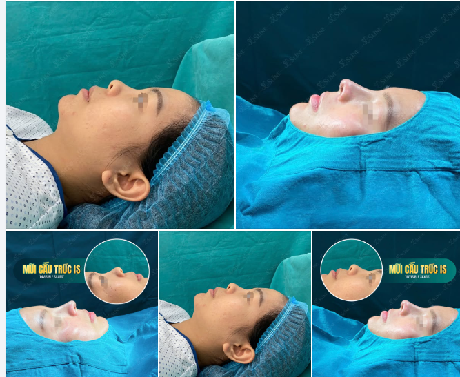 ĐẸP TINH TẾ, KHÓ THẤY DẤU VẾT
