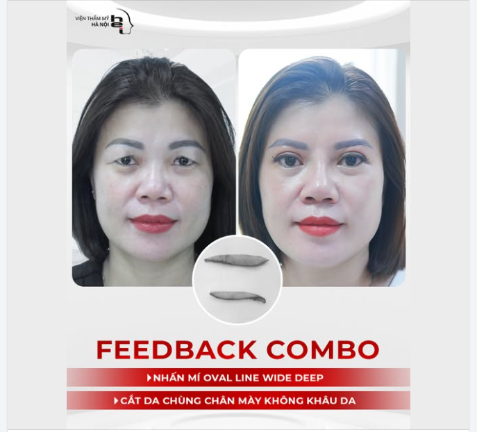 COMBO TRẺ HOÁ ĐÔI MẮT chỉ sau 60 phút