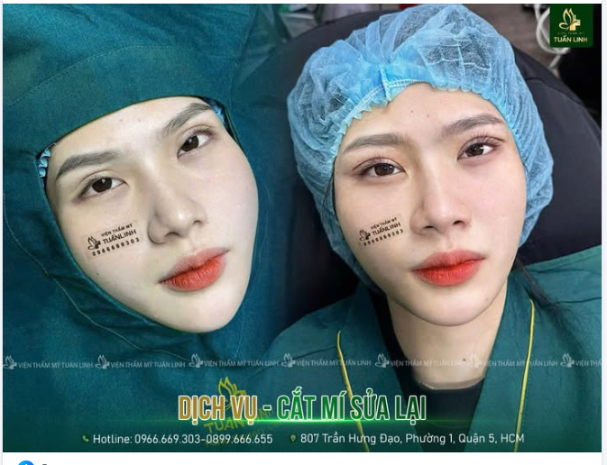 Cắt mí sửa lại tại Tuấn Linh sẽ khắc phục mọi khuyết điểm mí.
