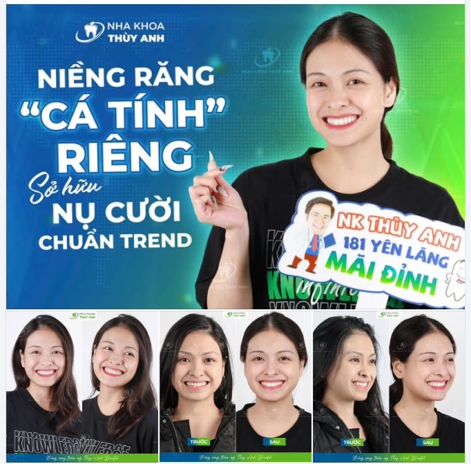 XOÁ BỎ KHỚP CẮN ĐỐI ĐẦU - LOẠI BỎ NGUY CƠ MÒN RĂNG, VIÊM KHỚP THÁI DƯƠNG HÀM CHO ANH VŨ