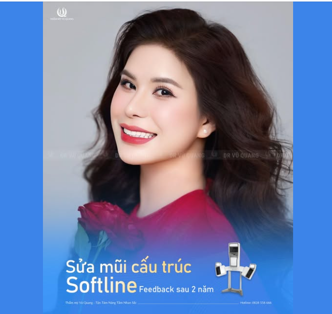SỬA MŨI SOFTLINE SAU 2 NĂM - AI NHÌN CŨNG KHEN