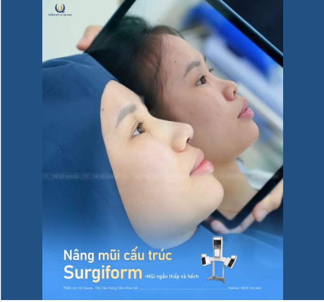KHÁM PHÁ KẾT QUẢ NÂNG MŨI SURGIFORM CỦA CÔ NÀNG ĐƯỢC CHỒNG “HỘ TỐNG” ĐI LÀM ĐẸP!