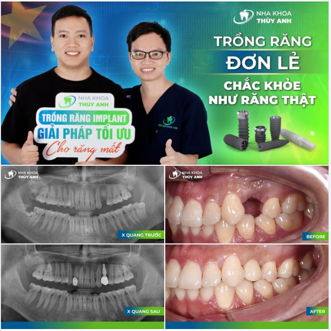 CHỌN TRỒNG RĂNG IMPLANT - CHỌN SỰ BỀN VỮNG LÂU DÀI