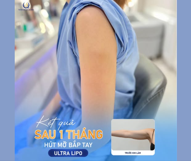 FEEDBACK HÚT MỠ BẮP TAY ULTRA LIPO SAU 1 THÁNG