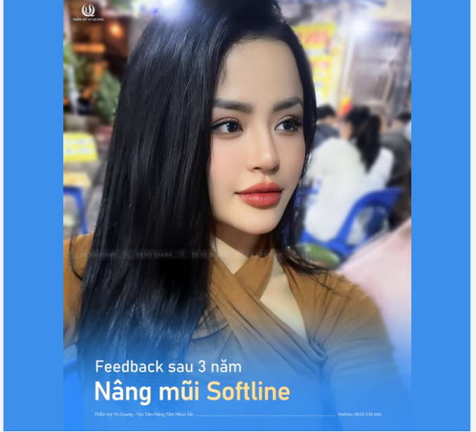 VÌ SAO NÂNG MŨI SOFTLINE TẠI DR VŨ QUANG ĐƯỢC KHÁCH HÀNG YÊU THÍCH?