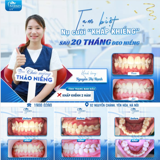 TẠM BIỆT NỤ CƯỜI LỆCH LẠC SAU 20 THÁNG ĐEO NIỀNG