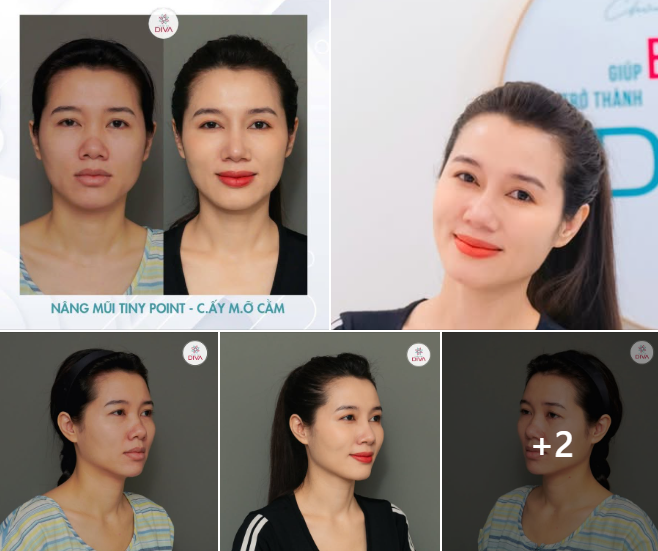 THAY ĐỔI NHẸ NHÀNG - MANG LẠI THẦN THÁI KHÁC BIỆT VỚI NÂNG MŨI TINY POINT VÀ CẤY MỠ CẰM