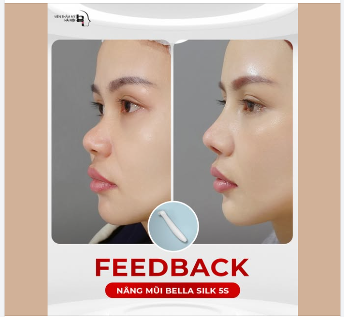 NÂNG MŨI BELLA SILK 5S – TINH TẾ TỪNG ĐƯỜNG NÉT