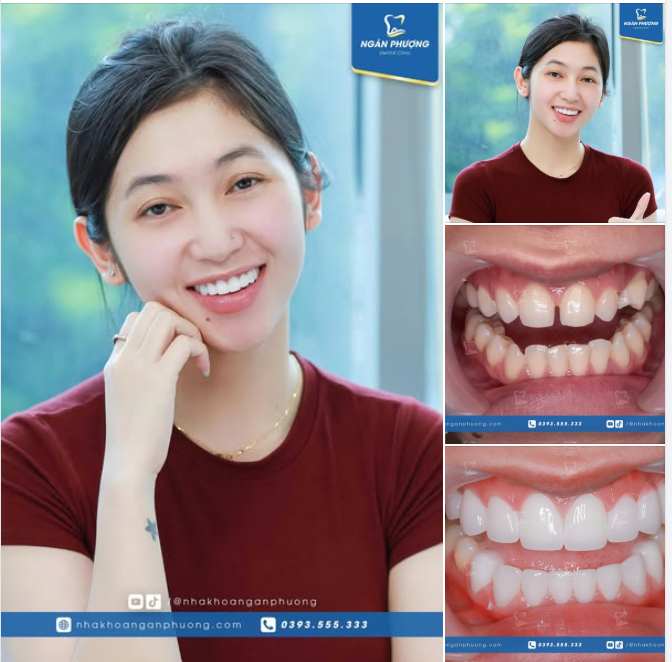 Nụ cười mới trắng sáng hơn cả yêu chỉ sau 3 ngày