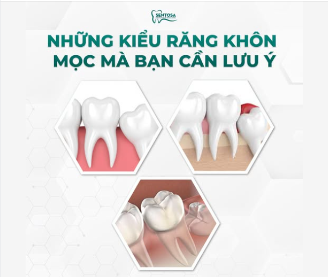 NHỮNG KIỂU RĂNG KHÔN MỌC MÀ BẠN CẦN LƯU Ý