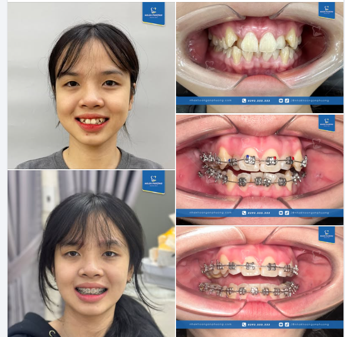 Đoạn nghị luận nghìn chữ cũng không tả hết sự thần kì của chỉnh nha