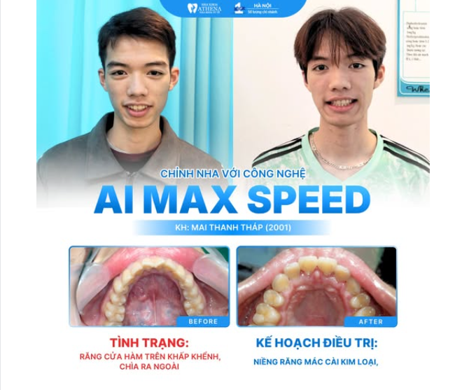 CHÚC MỪNG THÁO NIỀNG THÀNH CÔNG