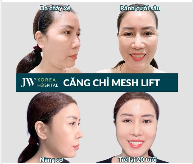 HỒI SINH THANH XUÂN: QUÝ CÔ U60 HẾT NHĂN, DA CĂNG MỊN NHƯ GÁI 18 SAU CĂNG CHỈ MESH LIFT TẠI JW