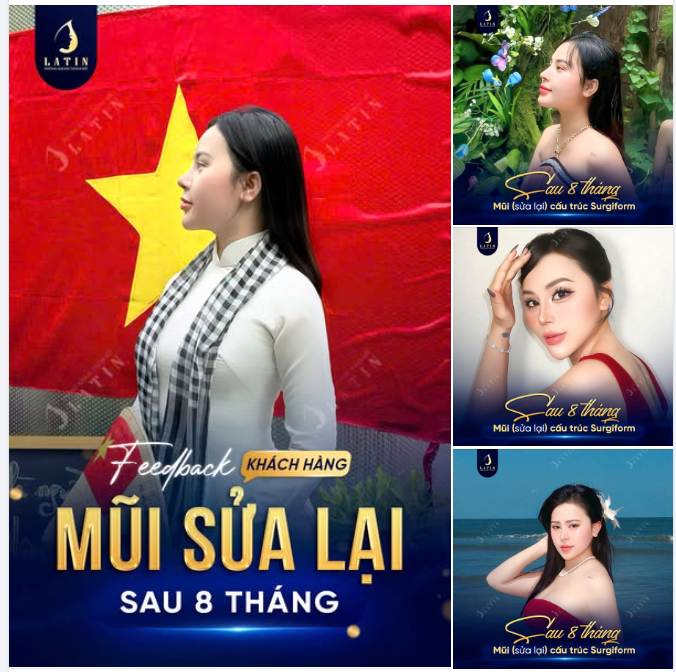 Mũi nâng hỏng là dấu chấm hết cho nhan sắc và sự tự tin?  Câu trả lời là KHÔNG