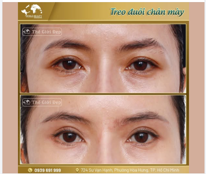 Thay vì phải cắt mí toàn phần, bác sĩ tại Thế Giới Đẹp đã lựa chọn phương pháp Treo đuôi chân mày – một thủ thuật tinh gọn nhưng mang lại hiệu quả rõ rệt cho đôi mắt.