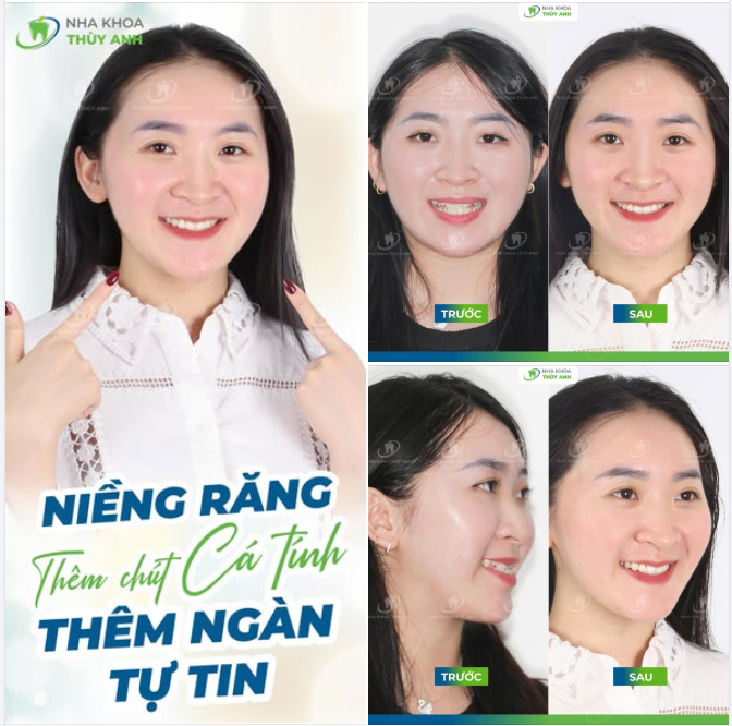 KHỚP CẮN NGƯỢC VÀ LỜI GIẢI TỪ NIỀNG RĂNG CHO BẠN NỤ CƯỜI RẠNG RỠ