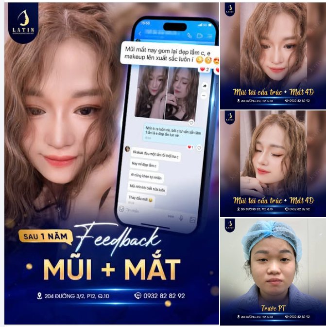 “Ai cũng khen tự nhiên, mũi nhìn không biết sửa luôn” – Feedback của khách sau 1 năm làm combo mũi + mắt tại Latin.