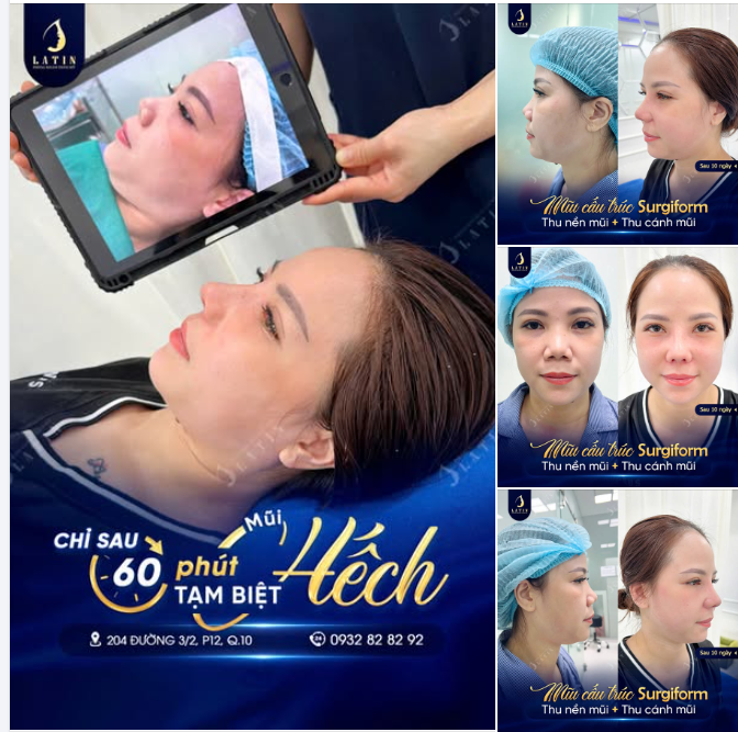 MŨI CẤU TRÚC SURGIFORM SAU 10 NGÀY TẠI LATIN