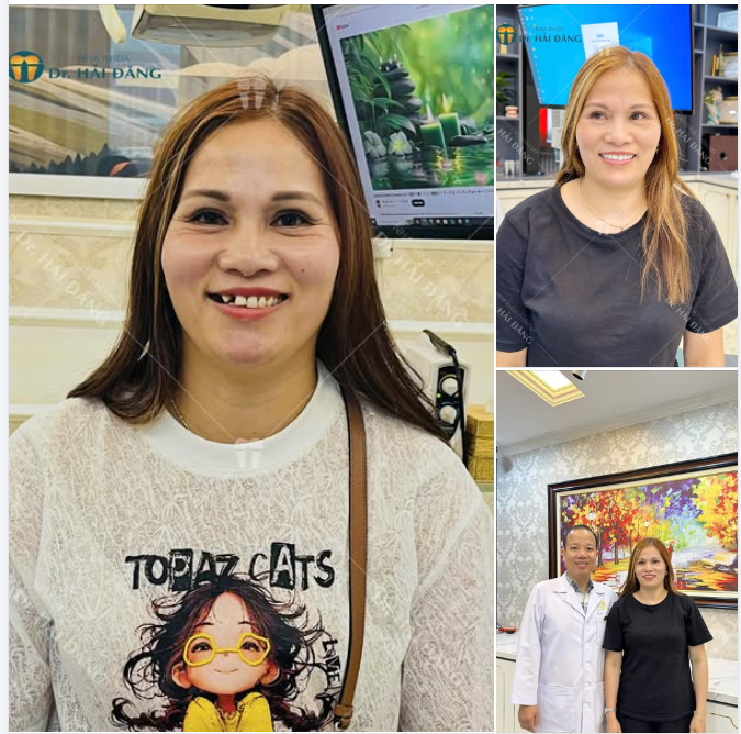 NỤ CƯỜI RẠNG RỠ SAU KHI BỌC 20 RĂNG SỨ