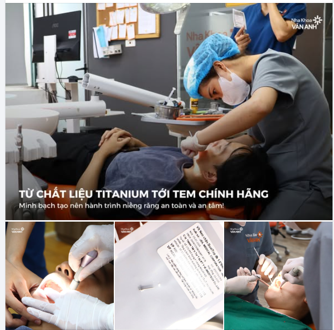 Khi nghe đến “cắm vis” trong chỉnh nha, nhiều khách hàng và cả phụ huynh thường lo lắng: