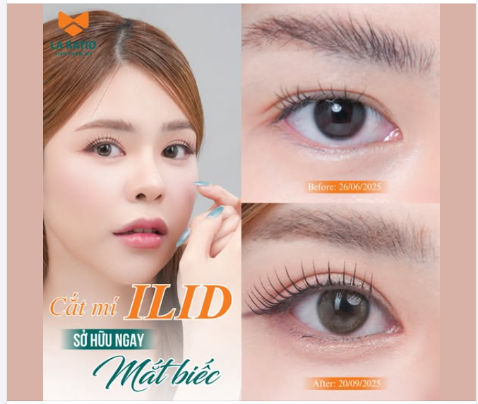 ​​​​​​​ Sau 7 ngày, chị đến Viện để cắt chỉ, mắt gần như hồi phục, không sưng bầm nhiều, vào form rất nhanh.