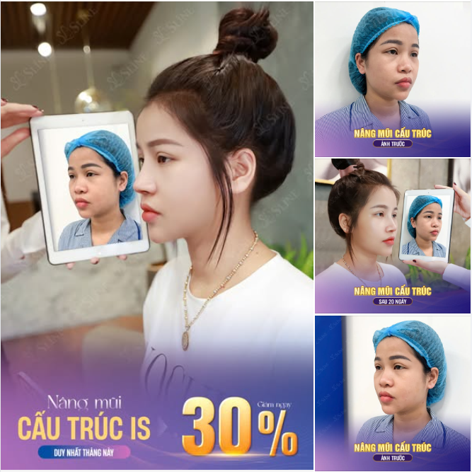 HÀNH TRÌNH THAY ĐỔI DÁNG MŨI – KHÁCH HÀNG NÓI GÌ?