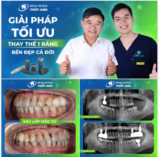 NIỀM HẠNH PHÚC Ở TUỔI TRUNG NIÊN KHI NHỮNG RĂNG HÀM NHAI BỊ MẤT ĐƯỢC KHÔI PHỤC