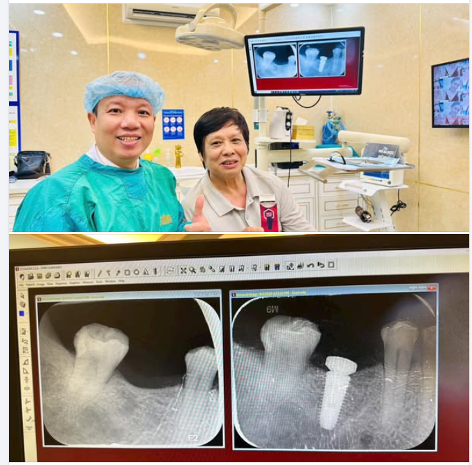 TRỒNG RĂNG IMPLANT - GIẢI PHÁP BỀN VỮNG CHO NỤ CƯỜI KHOẺ MẠNH