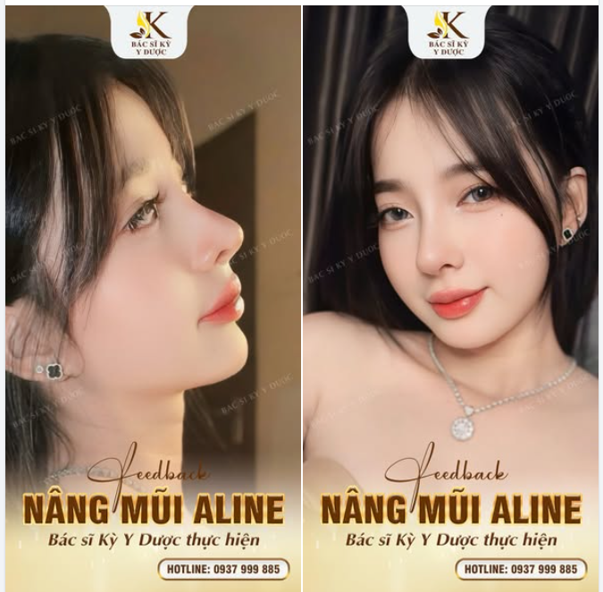 Feedback khách hàng sau Nâng Mũi ALINE tại Bác sĩ Kỳ Y Dược