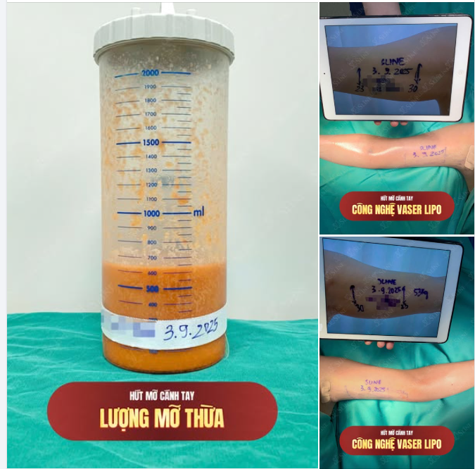 HÚT MỠ CÁNH TAY – VASER LIPO HIỆN ĐẠI