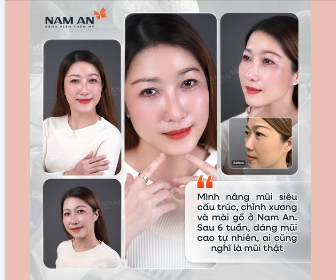 Dáng mũi mới – Tự nhiên đến khó tin
