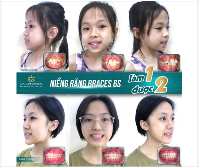 Tình yêu thương của bố mẹ đôi khi được gửi gắm trong một quyết định - cho con niềng răng sớm.