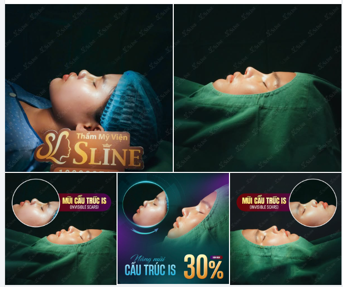 NÂNG MŨI CẤU TRÚC IS – TẠO DÁNG MŨI CHUẨN TỶ LỆ VÀNG