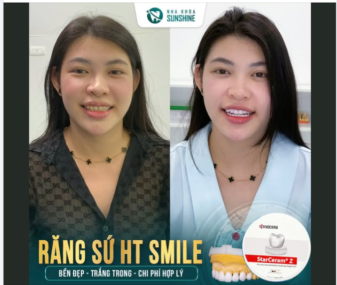 NỤ CƯỜI ĐẸP - TỰ TIN TỎA SÁNG VỚI RĂNG SỨ HT SMILE