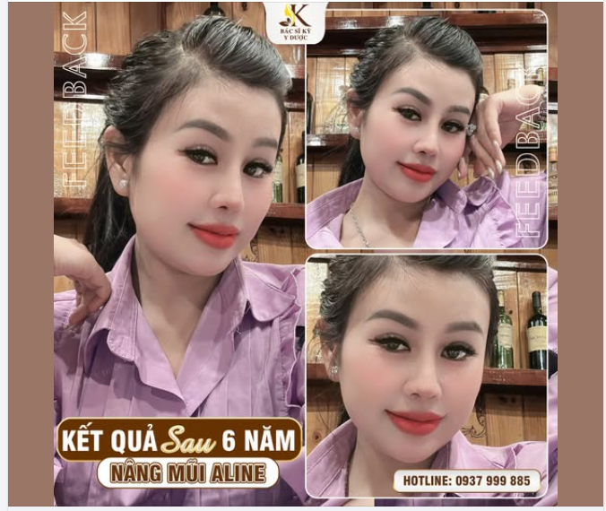 Feedback khách hàng – 6 năm sau Nâng mũi ALINE