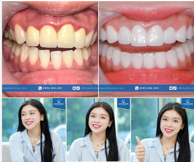 1 năm làm răng sứ của chị Kiều Yến sáng xinh như thế nào?