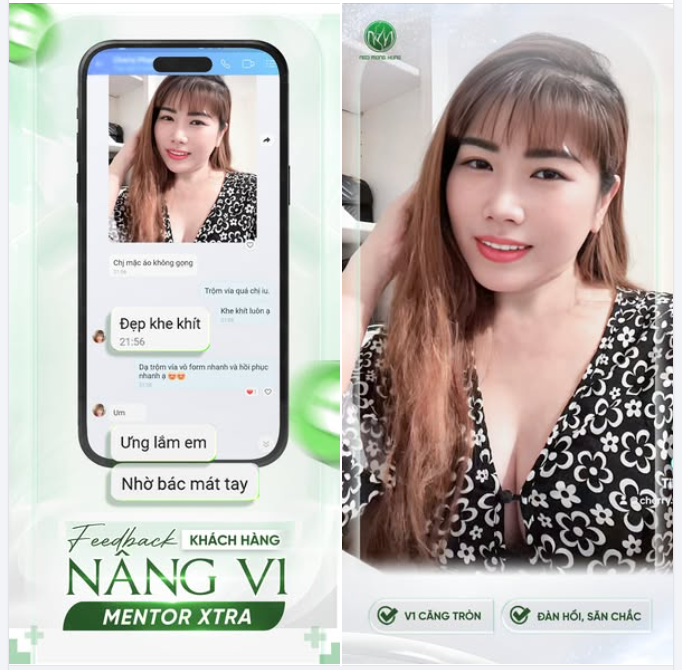 “Chị mặc áo không gọng, đẹp khe khít.” - Một phản hồi dễ thương từ khách hàng sau khi thực hiện Nâng V1 tại BVTM Ngô Mộng Hùng.