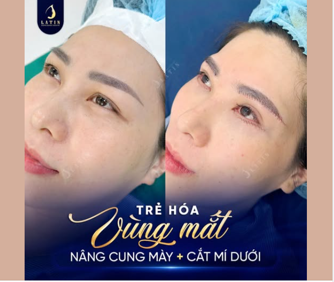 TRẺ HÓA VÙNG MẮT – BÍ QUYẾT GIỮ THANH XUÂN