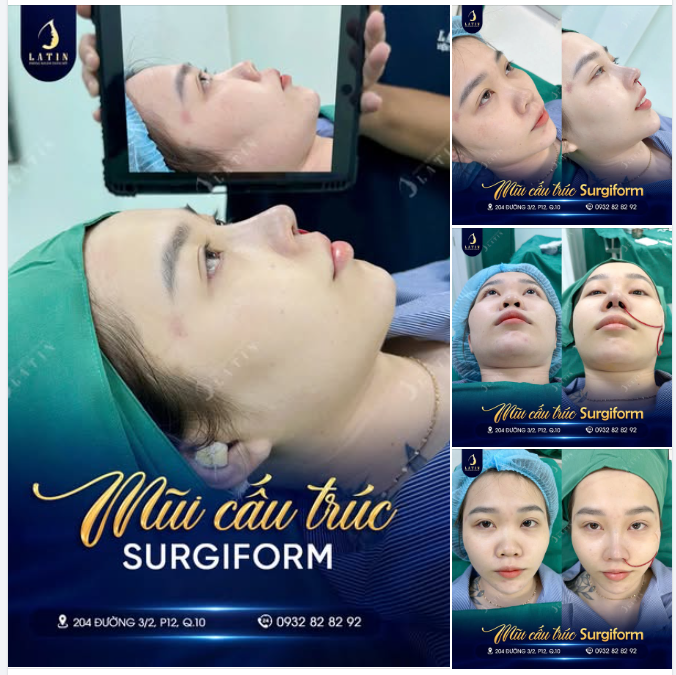 Nâng mũi không chỉ là thay đổi dáng mũi – mà còn là nâng tầm thần thái