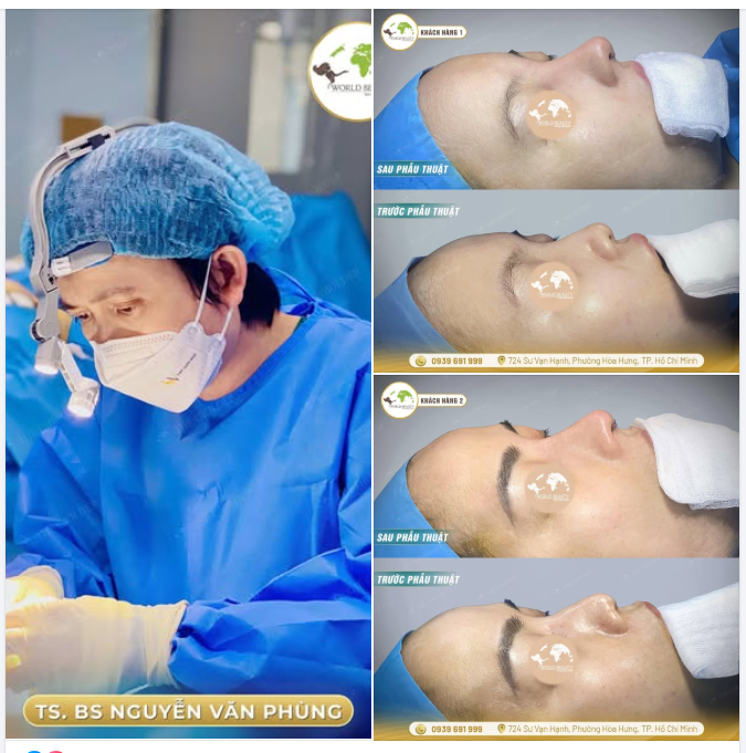  Vì sao nâng mũi cấu trúc được xem là giải pháp tối ưu