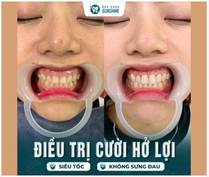 Bạn bị cười hở lợi, muốn điều trị nhưng lại: Sợ đau Sợ chảy máu ​​​​​​​ Sợ lâu lành