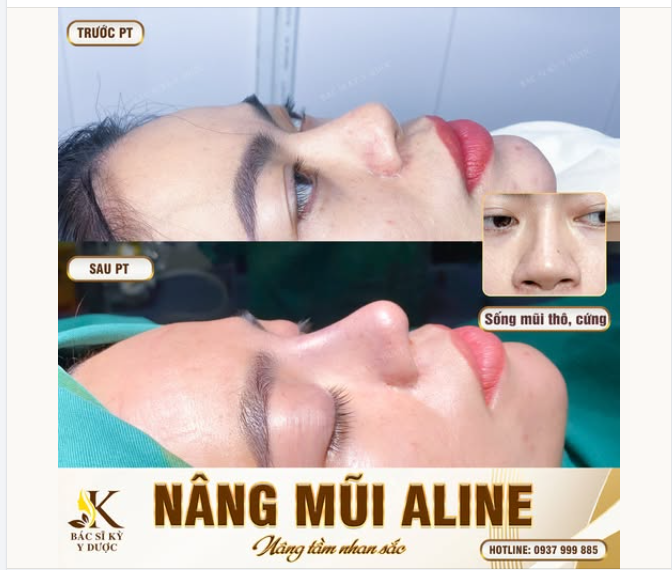 Kết quả Nâng Mũi ALINE ngay sau phẫu thuật tại Nha Trang