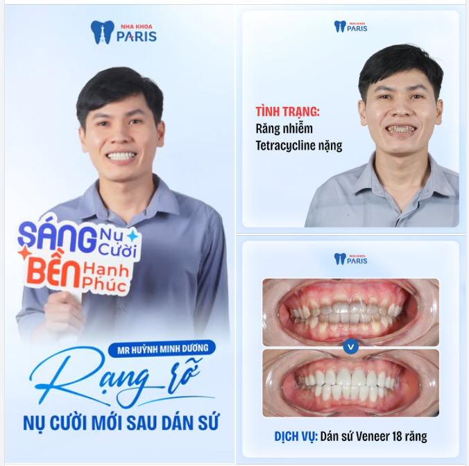 Rạng rỡ nụ cười mới sau dán sứ Veneer