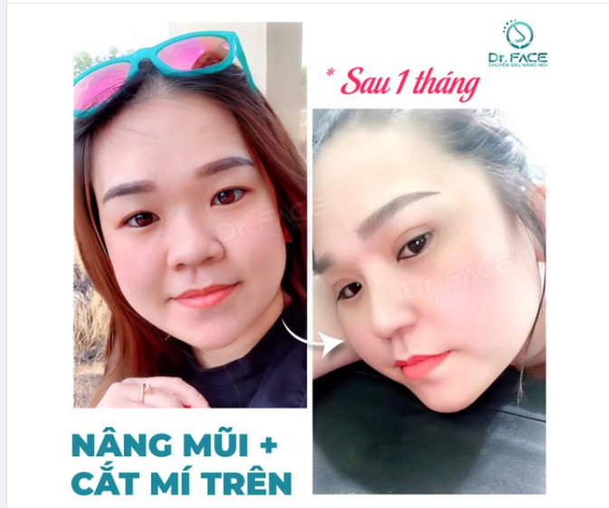 “Khoe nhẹ” MŨI – MẮT SAU 1 THÁNG đây cả nhà ơi!