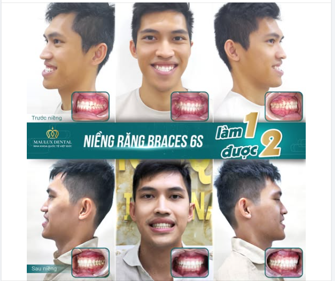 NIỀNG 1 ĐƯỢC 2 - CHỈNH RĂNG, CHỈNH LUÔN CẢ GƯƠNG MẶT